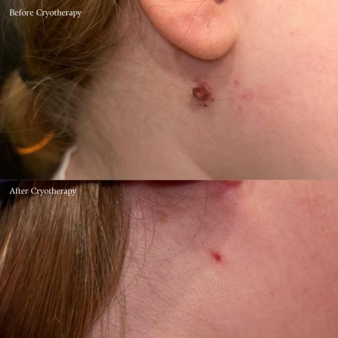 Skin Tag Removal
